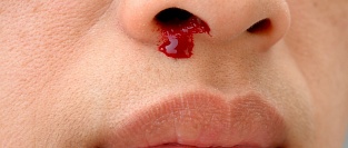 Носовые кровотечения. Информация для пациентов